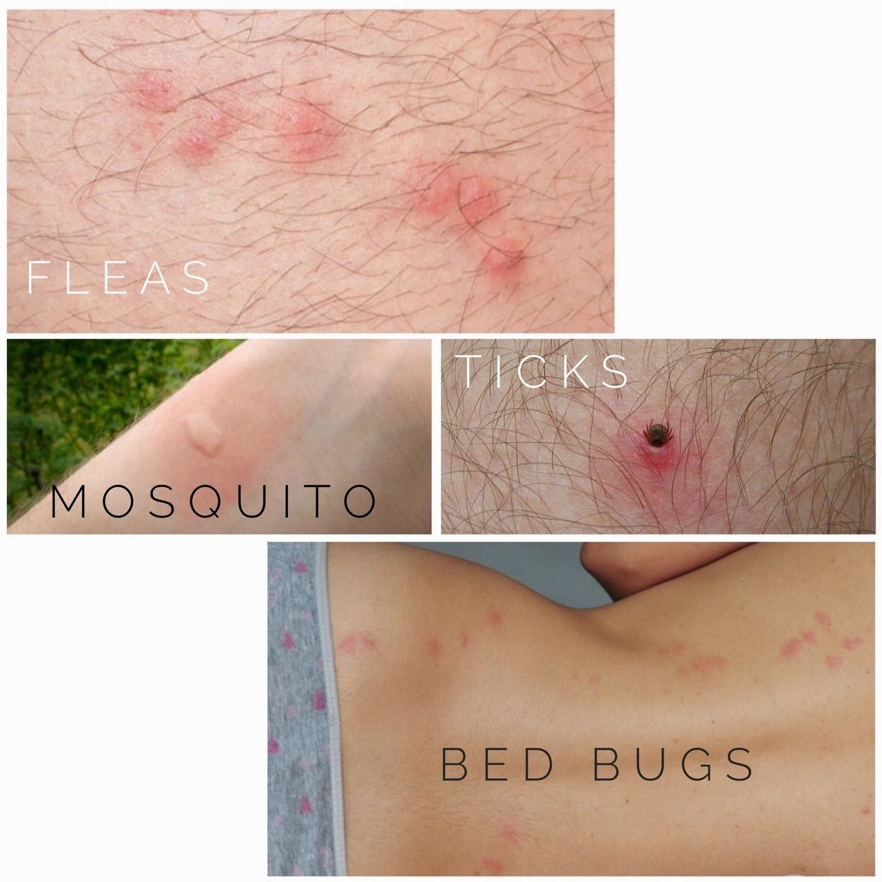 Flea, mosquito, tick and bed bug bites on humans. what bug is biting you.